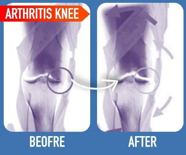 Nutripatch? Joint Arthritis Patch