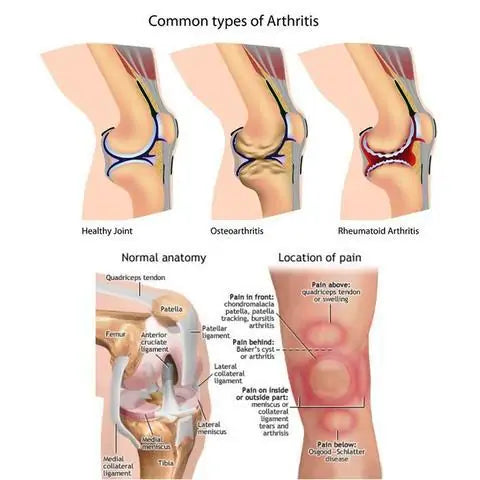 Nutripatch? Joint Arthritis Patch